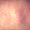 New Jersey Confirms First Measles Case